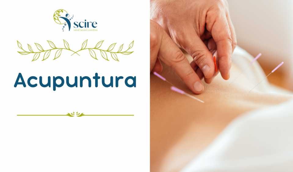 Acupuntura